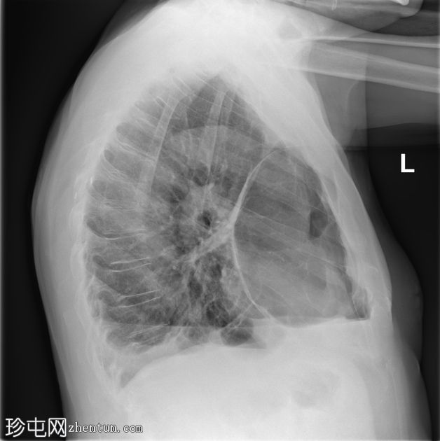 巨大大泡性肺气肿并发自发性气胸