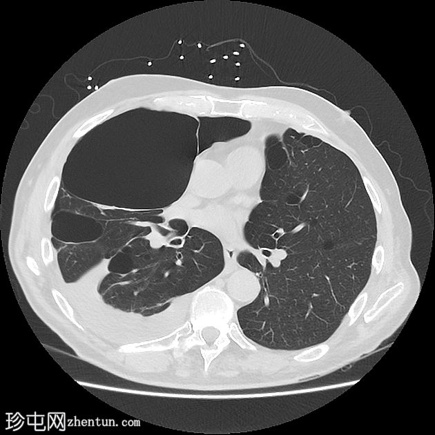 巨大大泡性肺气肿并发自发性气胸