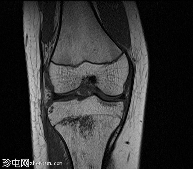 后交叉韧带撕脱骨折