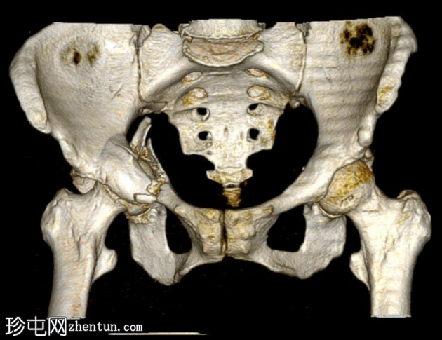 髋关节中央脱位伴有髋臼骨折