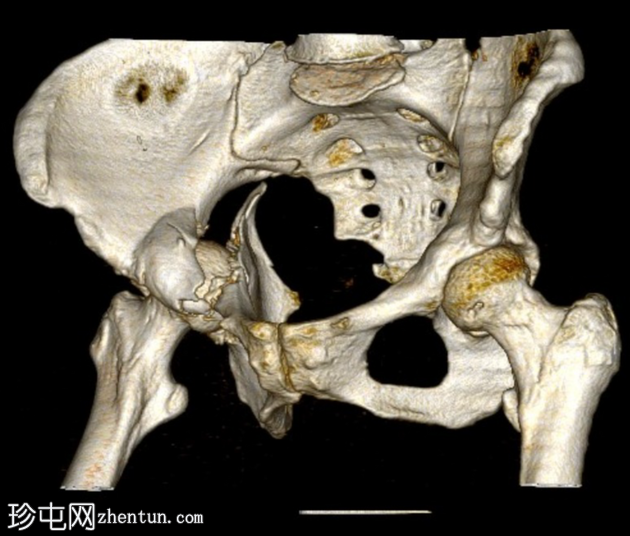 髋关节中央脱位伴有髋臼骨折