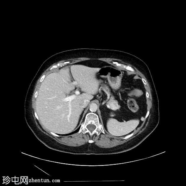 胰腺神经内分泌肿瘤及大体病理