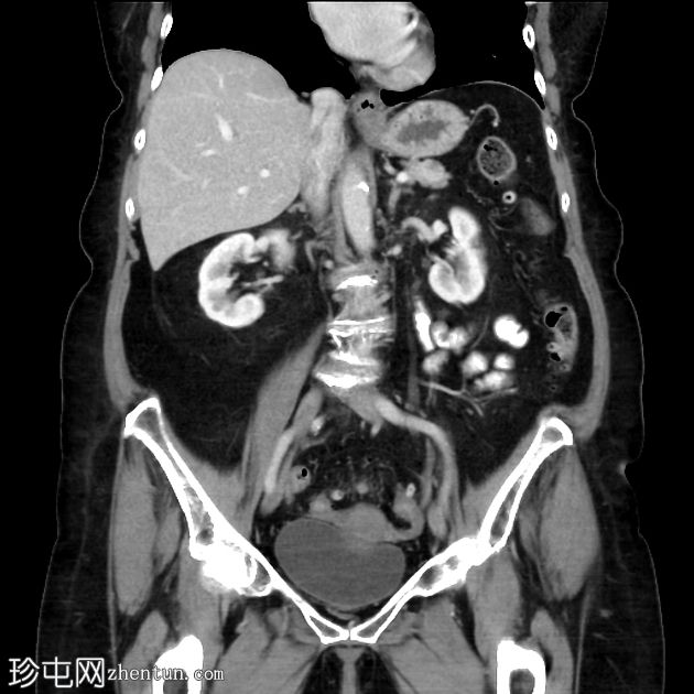 胰腺神经内分泌肿瘤及大体病理