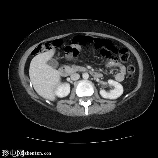 壶腹部周围胃肠道间质瘤 (GIST)