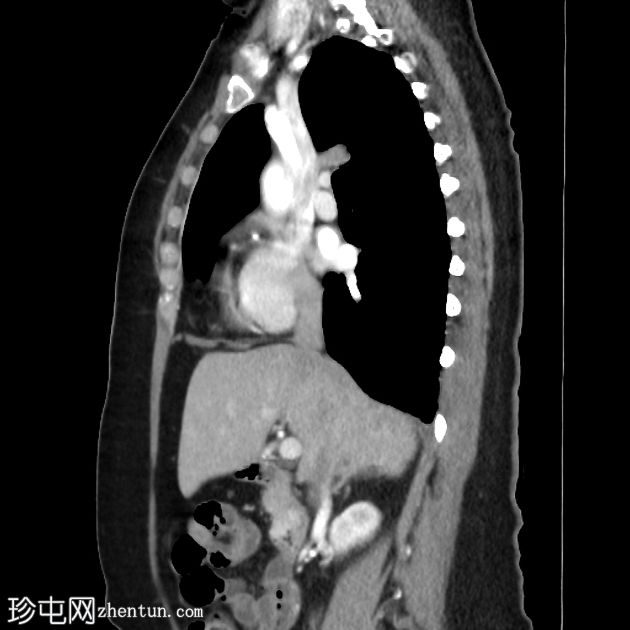 壶腹部周围胃肠道间质瘤 (GIST)