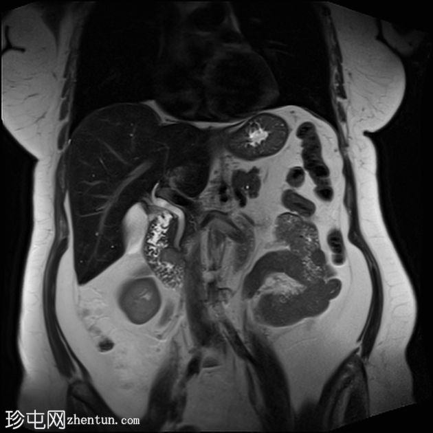 壶腹部周围胃肠道间质瘤 (GIST)