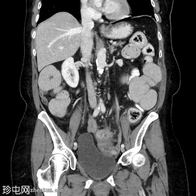 慢性瘘管性憩室炎