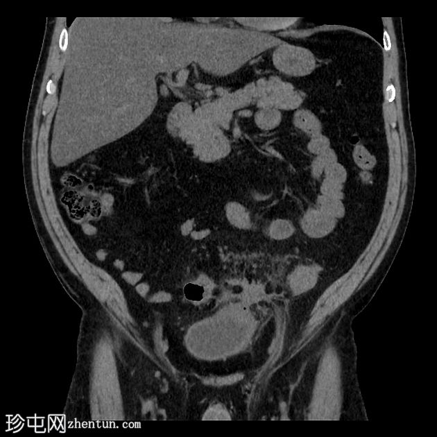 慢性瘘管性憩室炎