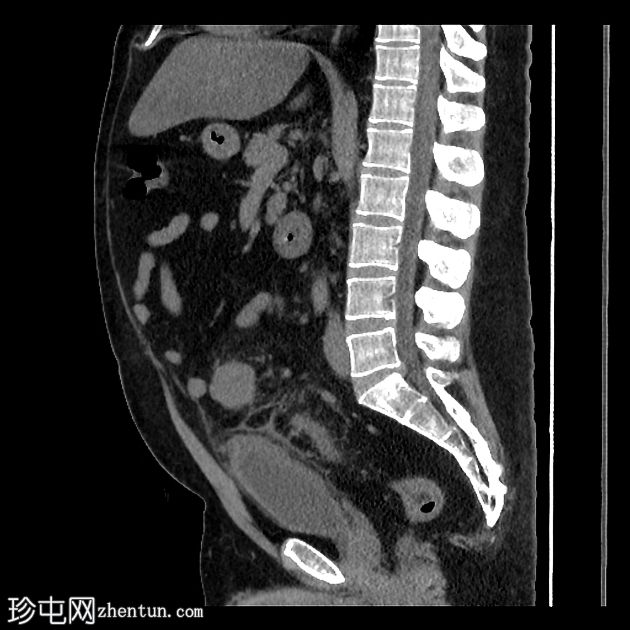 慢性瘘管性憩室炎