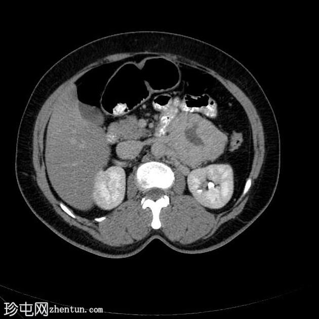 胰腺神经内分泌肿瘤