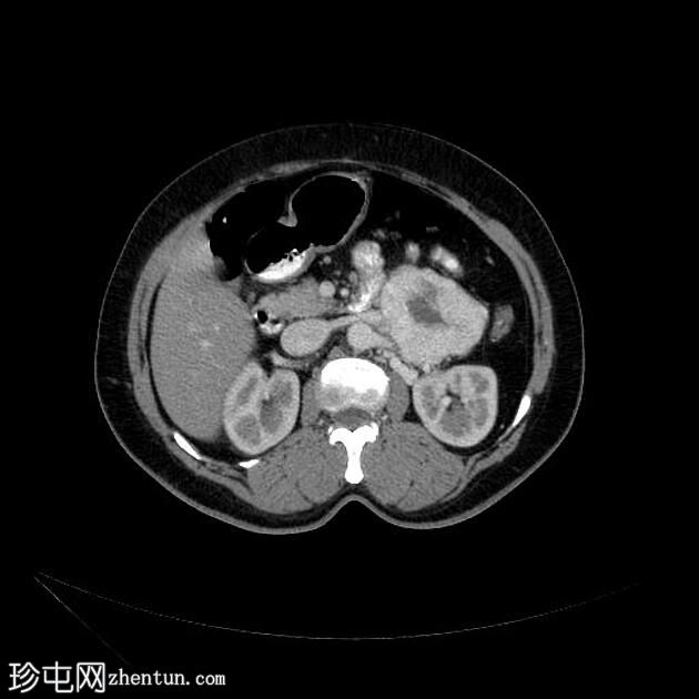 胰腺神经内分泌肿瘤