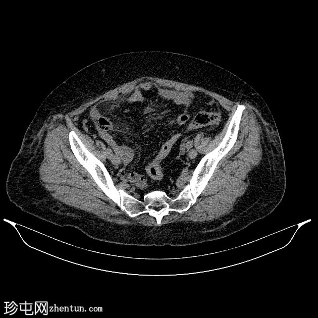 阑尾炎穿孔