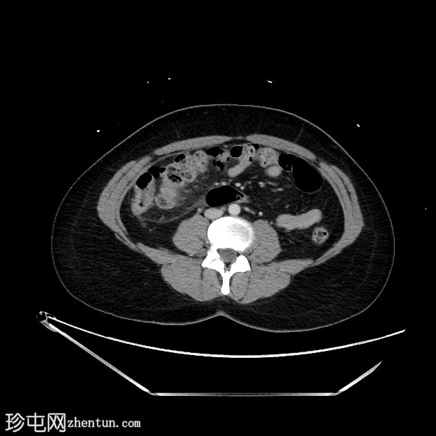 急性胆囊炎 - CT