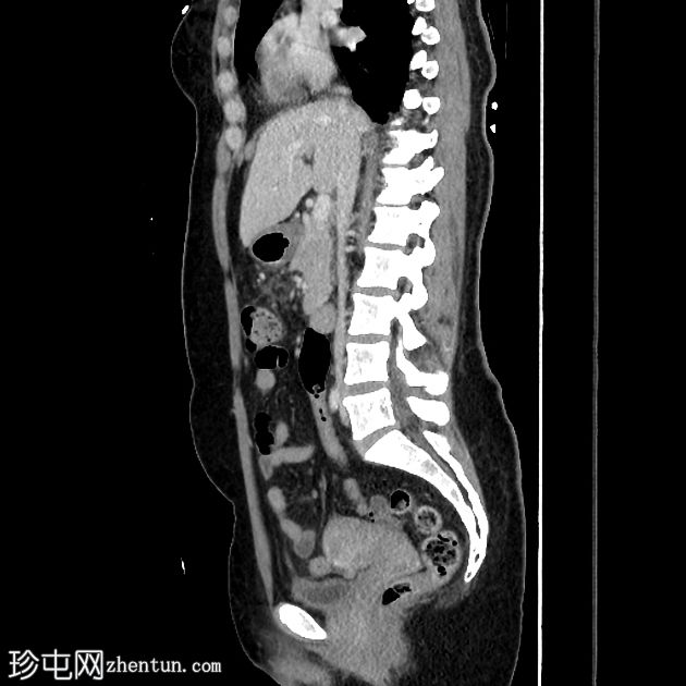 急性胆囊炎 - CT