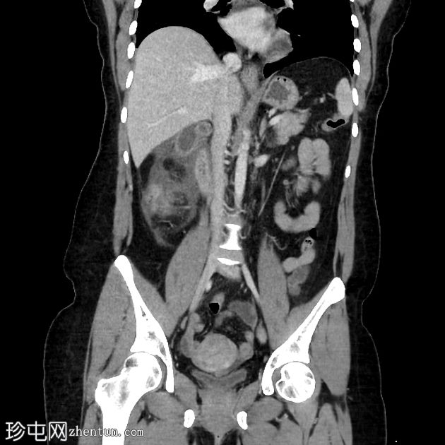 急性胆囊炎 - CT