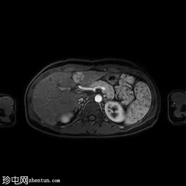 布德-加氏综合征