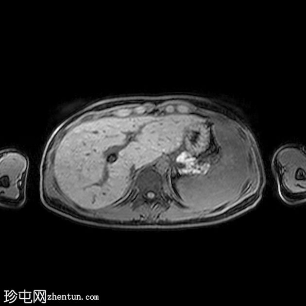 布德-加氏综合征