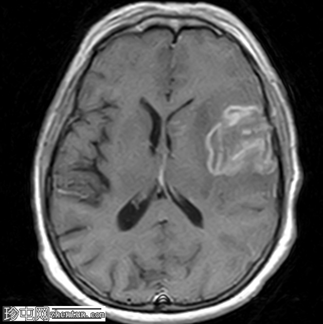 亚急性梗塞表现为周围强化病变