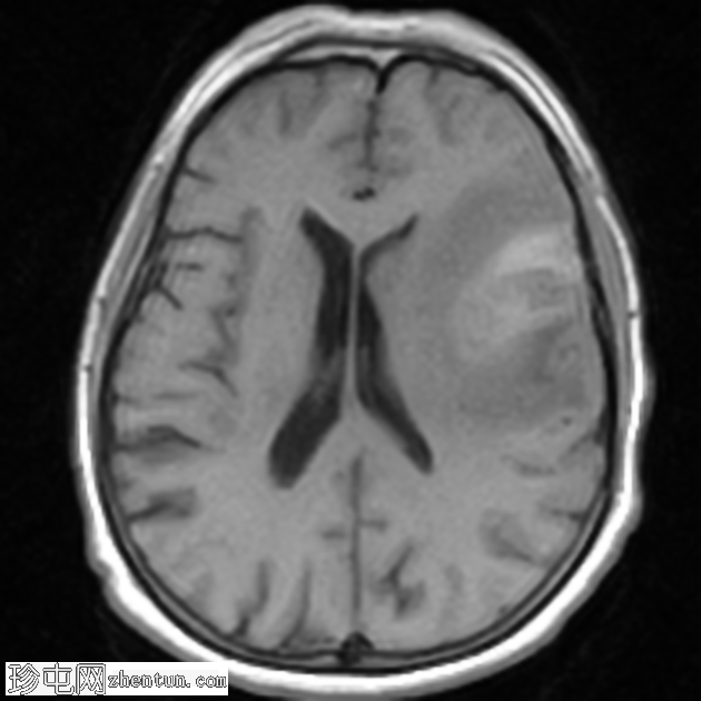 亚急性梗塞表现为周围强化病变