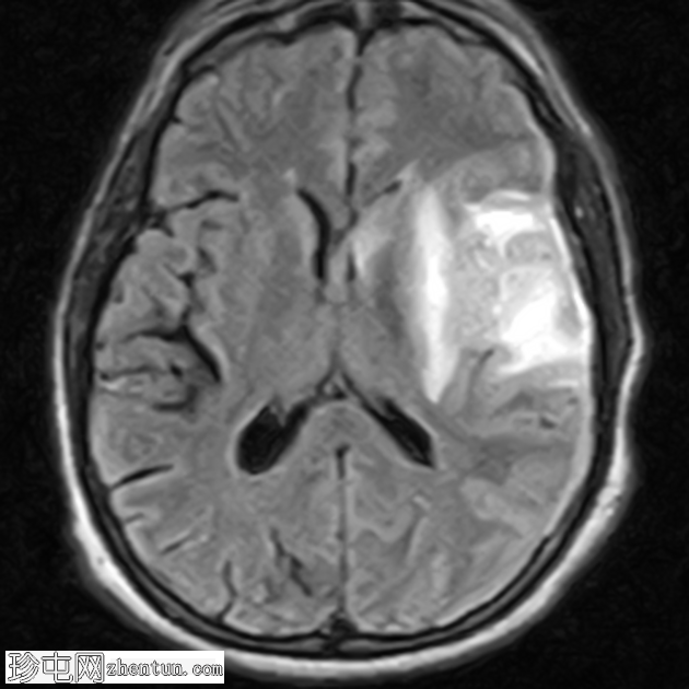 亚急性梗塞表现为周围强化病变