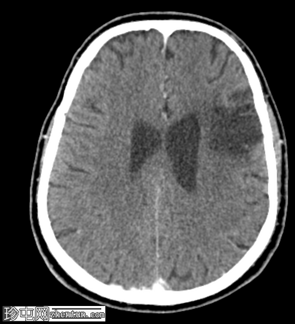 亚急性梗塞表现为周围强化病变