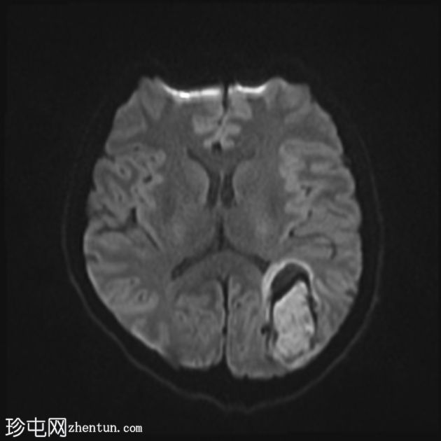 脑动静脉畸形伴出血