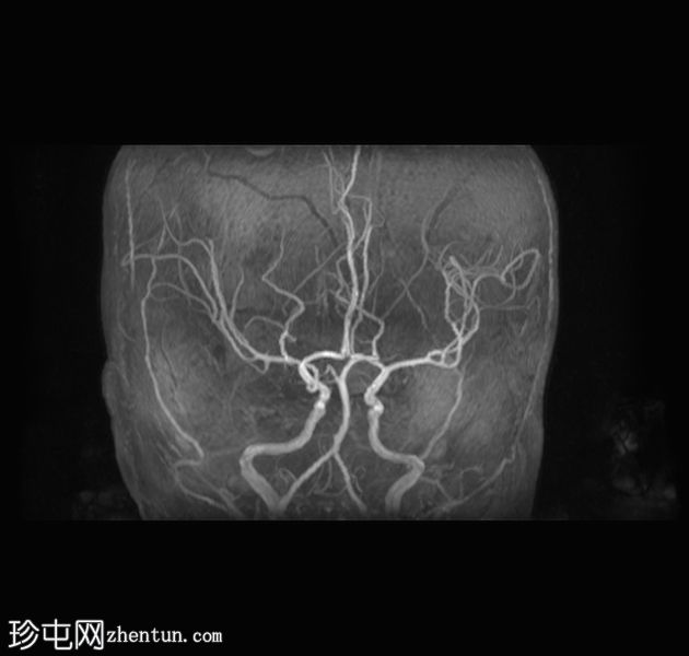 局灶性脑动脉病