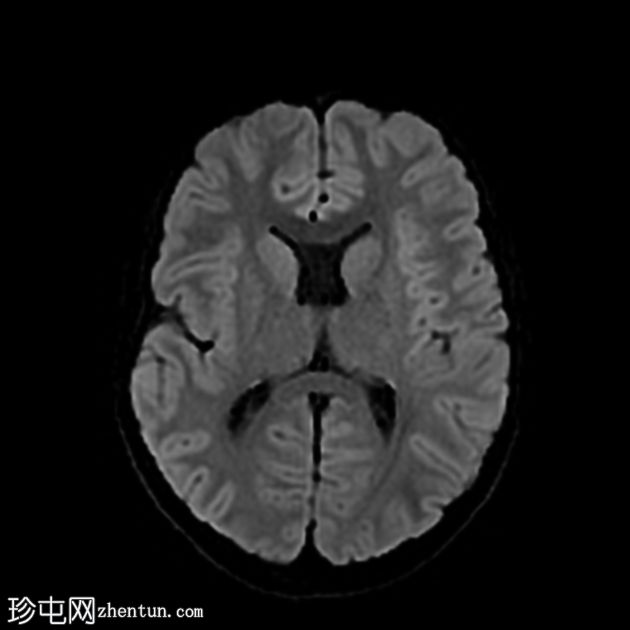 视中隔发育不良