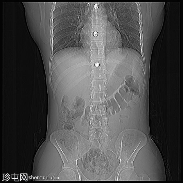 肝包虫囊破裂