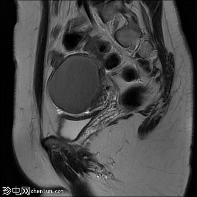 卵巢子宫内膜异位症