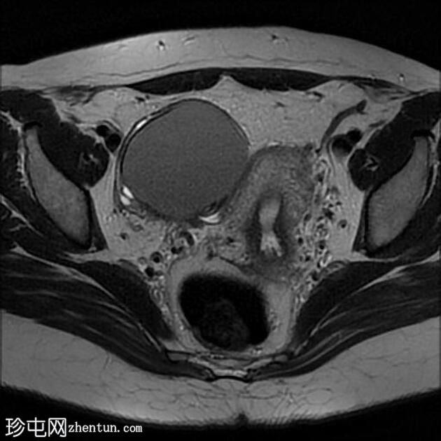 卵巢子宫内膜异位症