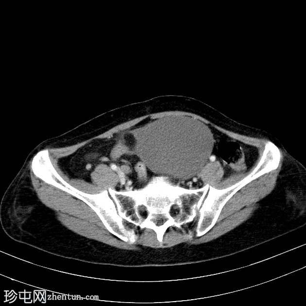 附件扭转