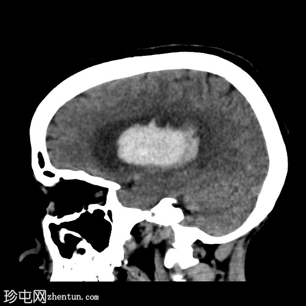 高血压脑出血