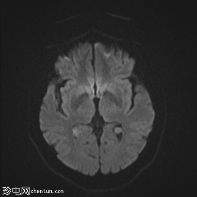 脉络丛黄色肉芽肿