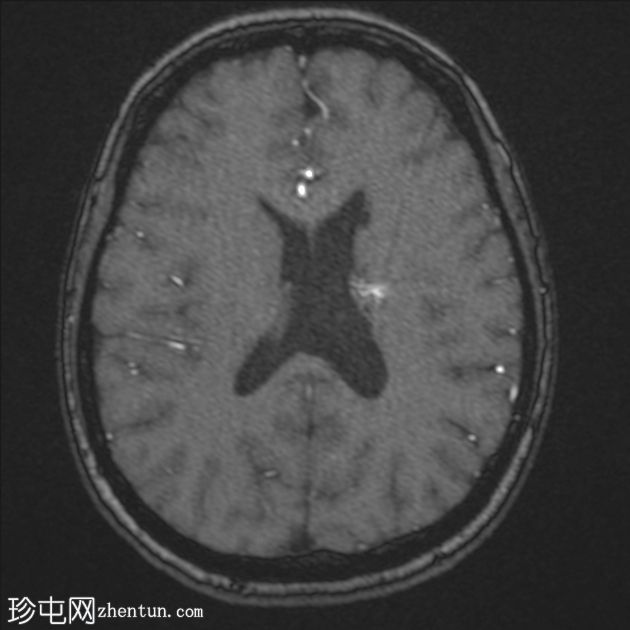 脑动静脉畸形，曾发生过出血