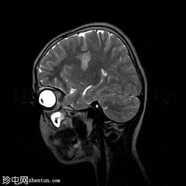 局部皮质发育不良-IIb 型