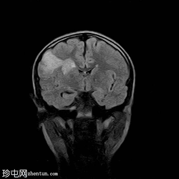 局部皮质发育不良-IIb 型