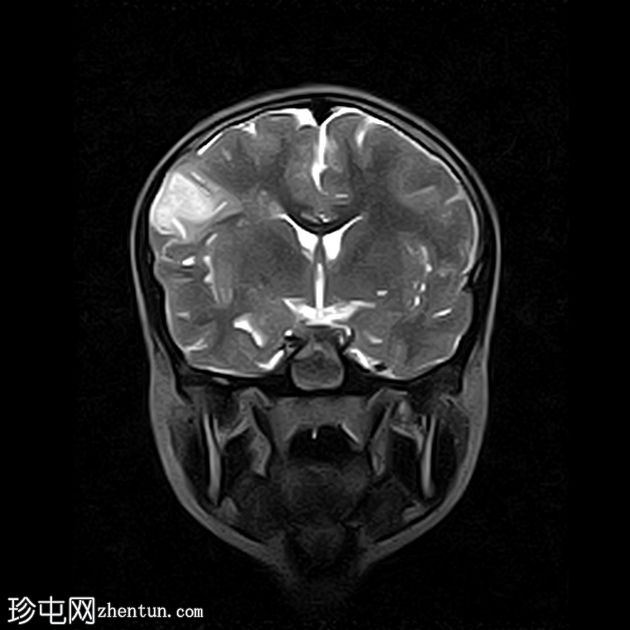 局部皮质发育不良-IIb 型