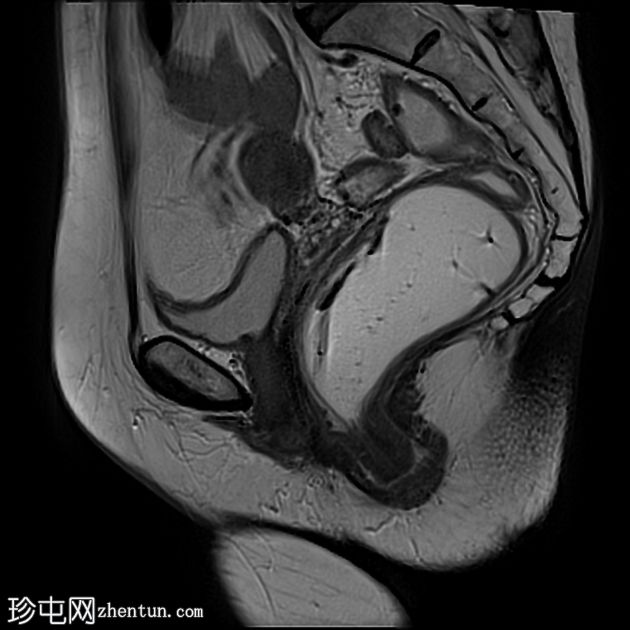 多部位脱垂的 MRI 排便造影