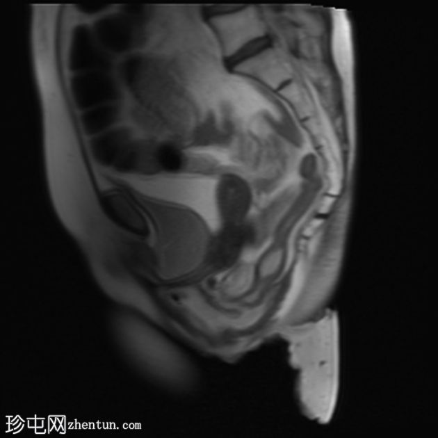 多部位脱垂的 MRI 排便造影