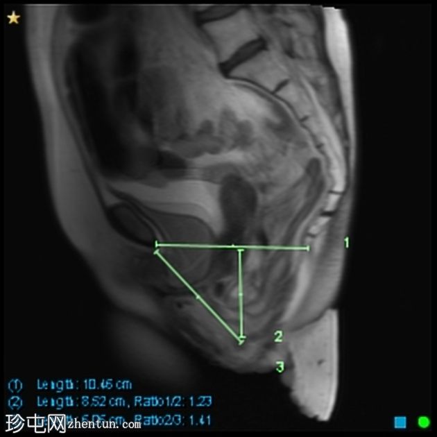 多部位脱垂的 MRI 排便造影