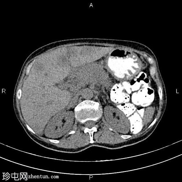 转移性胰腺导管腺癌