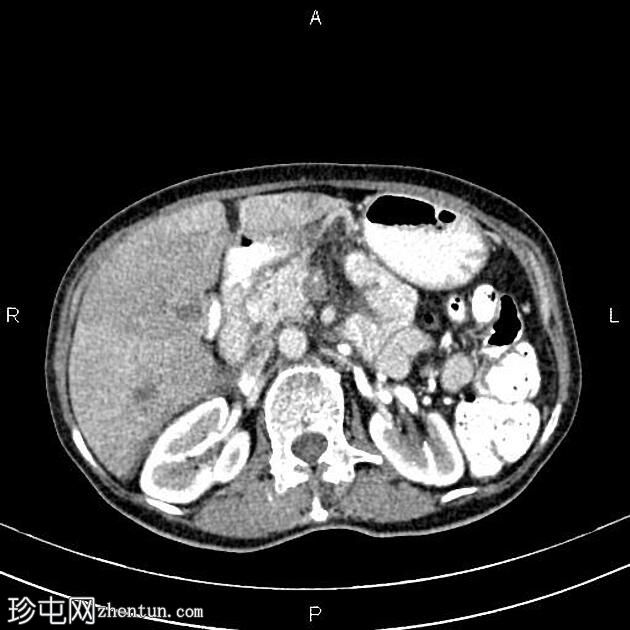 转移性胰腺导管腺癌