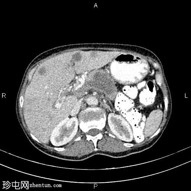 转移性胰腺导管腺癌