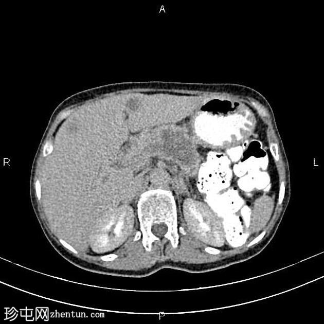 转移性胰腺导管腺癌