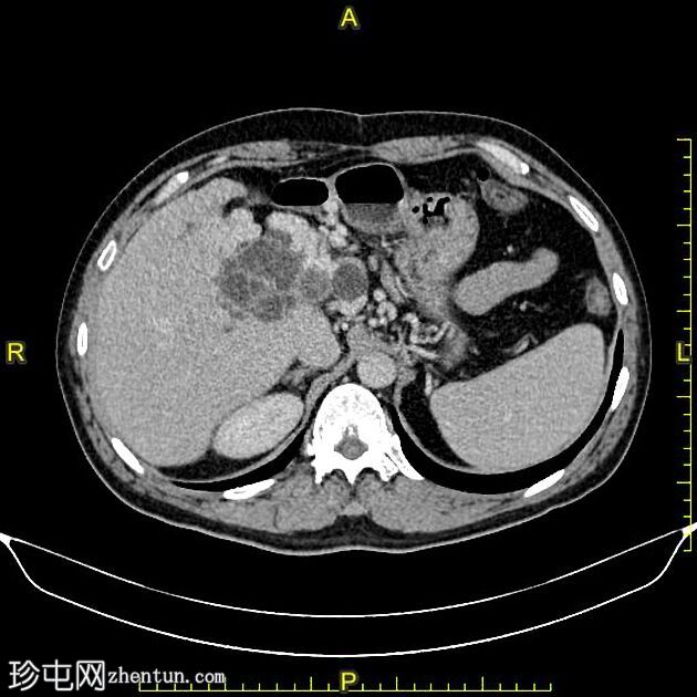 肝包虫囊肿胆管内破裂