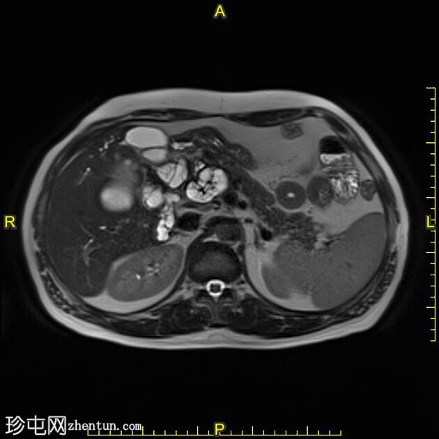 肝包虫囊肿胆管内破裂