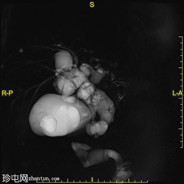 肝包虫囊肿胆管内破裂