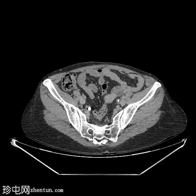 膀胱结石围绕残留导管