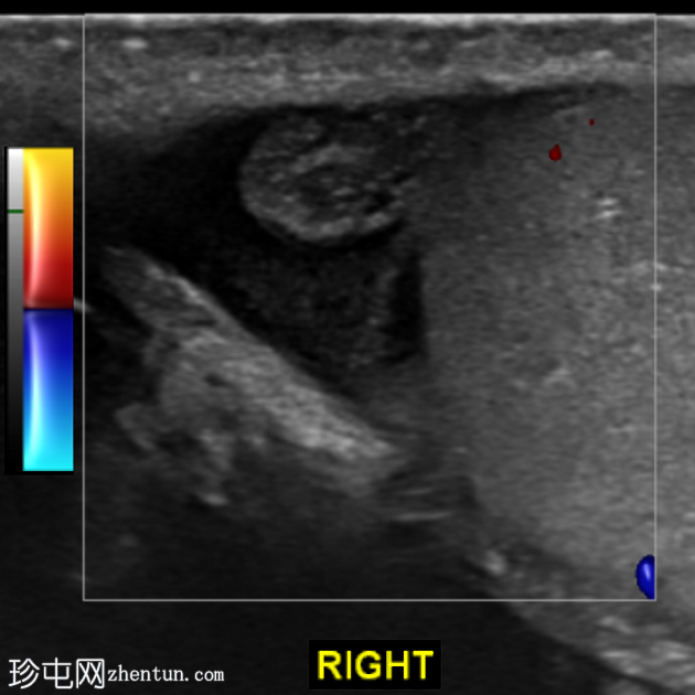 睾丸阑尾扭转